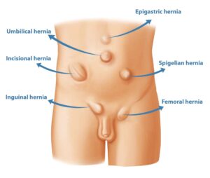 Types of Hernias